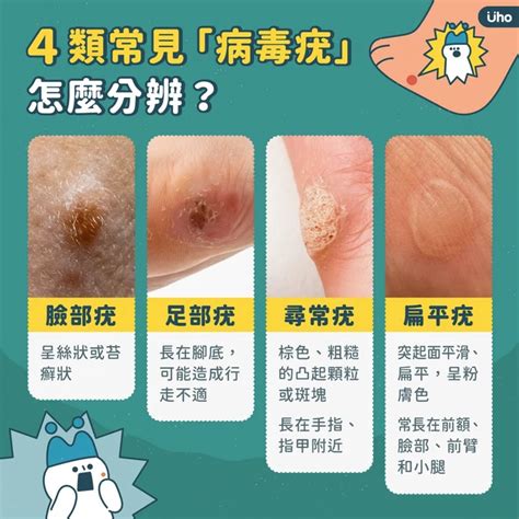 病毒疣 頭皮|病毒疣會自己好嗎？病毒疣初期照片、原因、6招預防